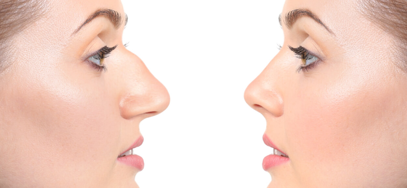 Burun Kemik Eğriliği 1 ankara burun kemik eğriliği tedavisi dr emre apaydın