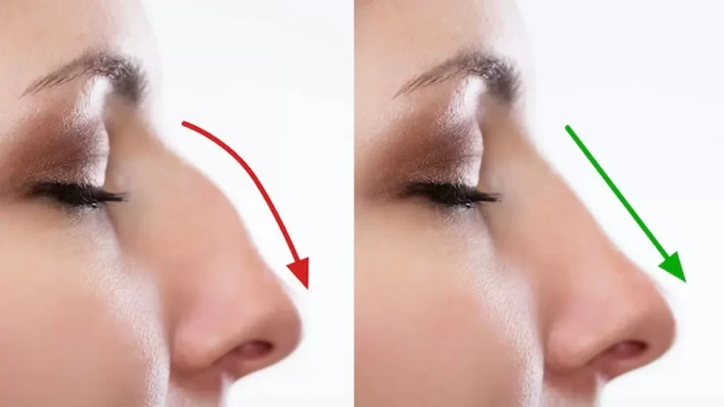 Ankara Burun Estetiği Fiyatları