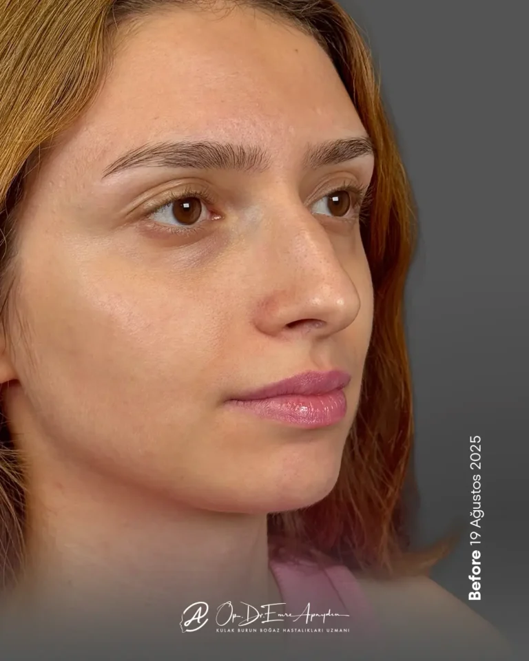 Rinoplasti öncesi, çeyrek profil görünüm; örnek 1