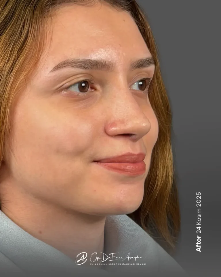 Rinoplasti sonrası, çeyrek profil görünüm; örnek 1