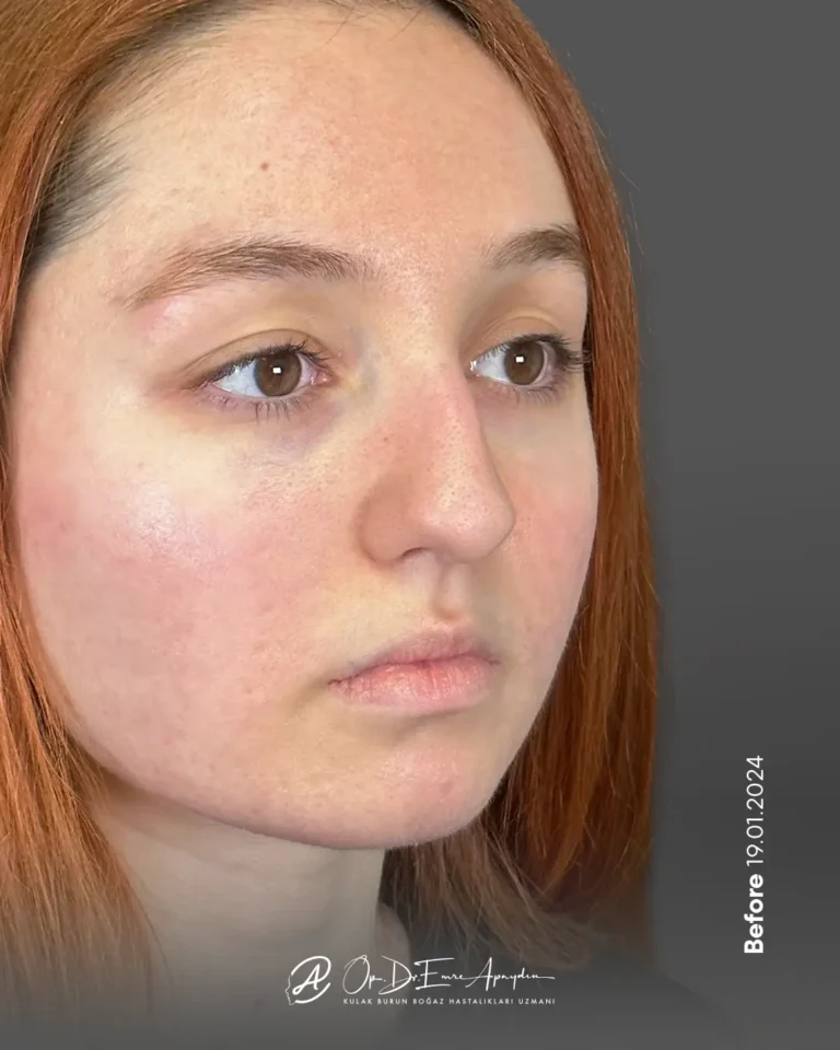 Rinoplasti öncesi, çeyrek profil görünüm; örnek 4