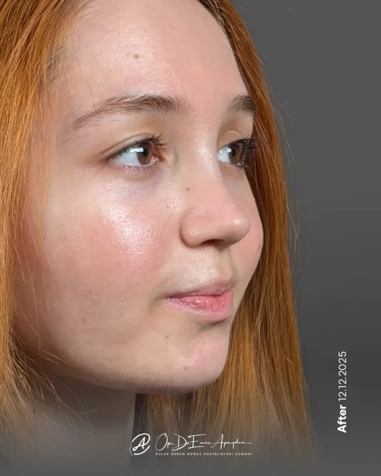 Rinoplasti sonrası, çeyrek profil görünüm; örnek 4