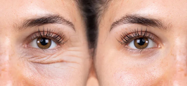 Ankara Endolift