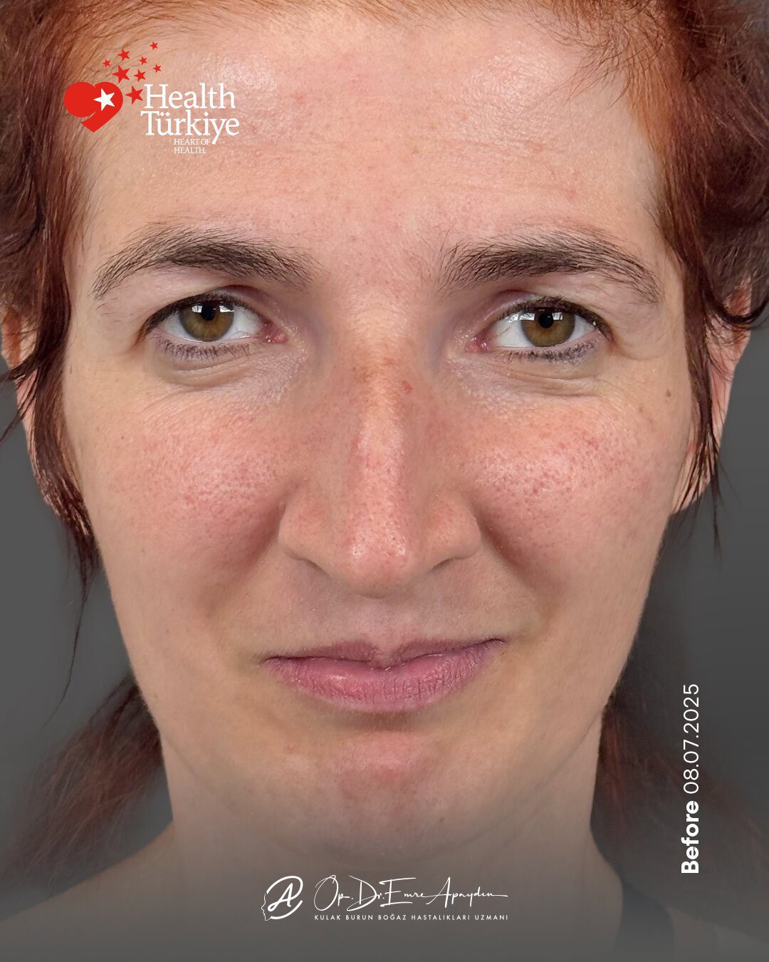 EA26 01d RinoplastiBeforeAfter