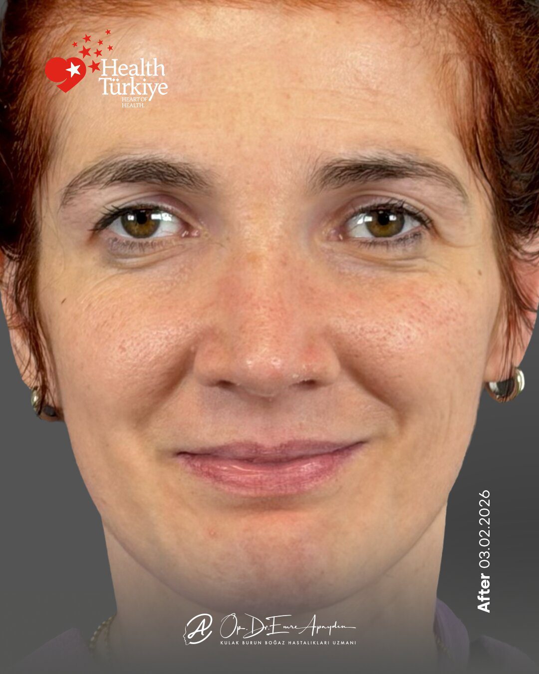 EA26 01e RinoplastiBeforeAfter