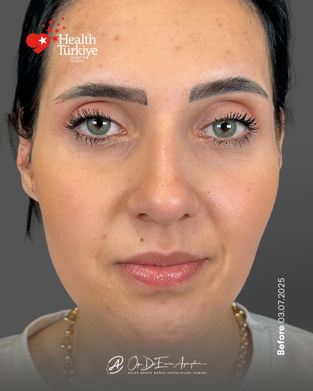 EA26 03e RinoplastiBeforeAfter