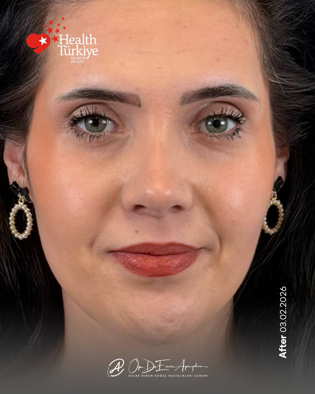 EA26 03f RinoplastiBeforeAfter
