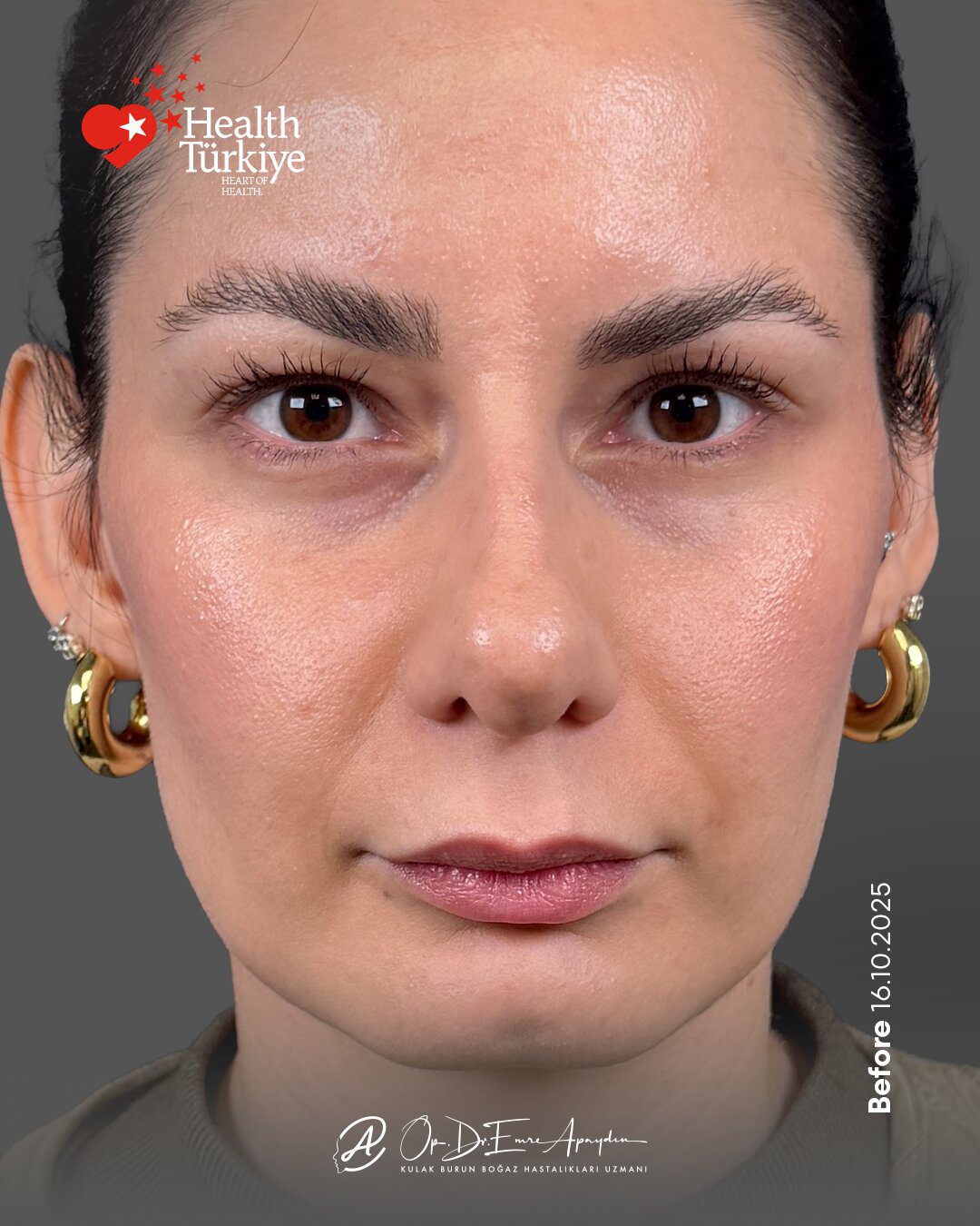 EA26 04c RinoplastiBeforeAfter