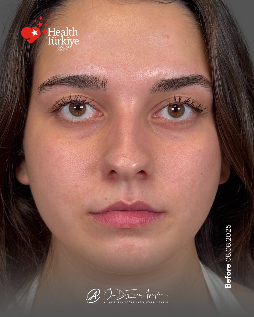 EA26 04d RinoplastiBeforeAfter 1