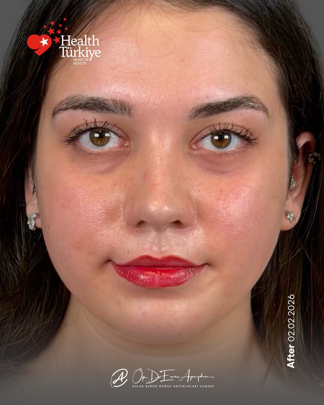 EA26 04e RinoplastiBeforeAfter