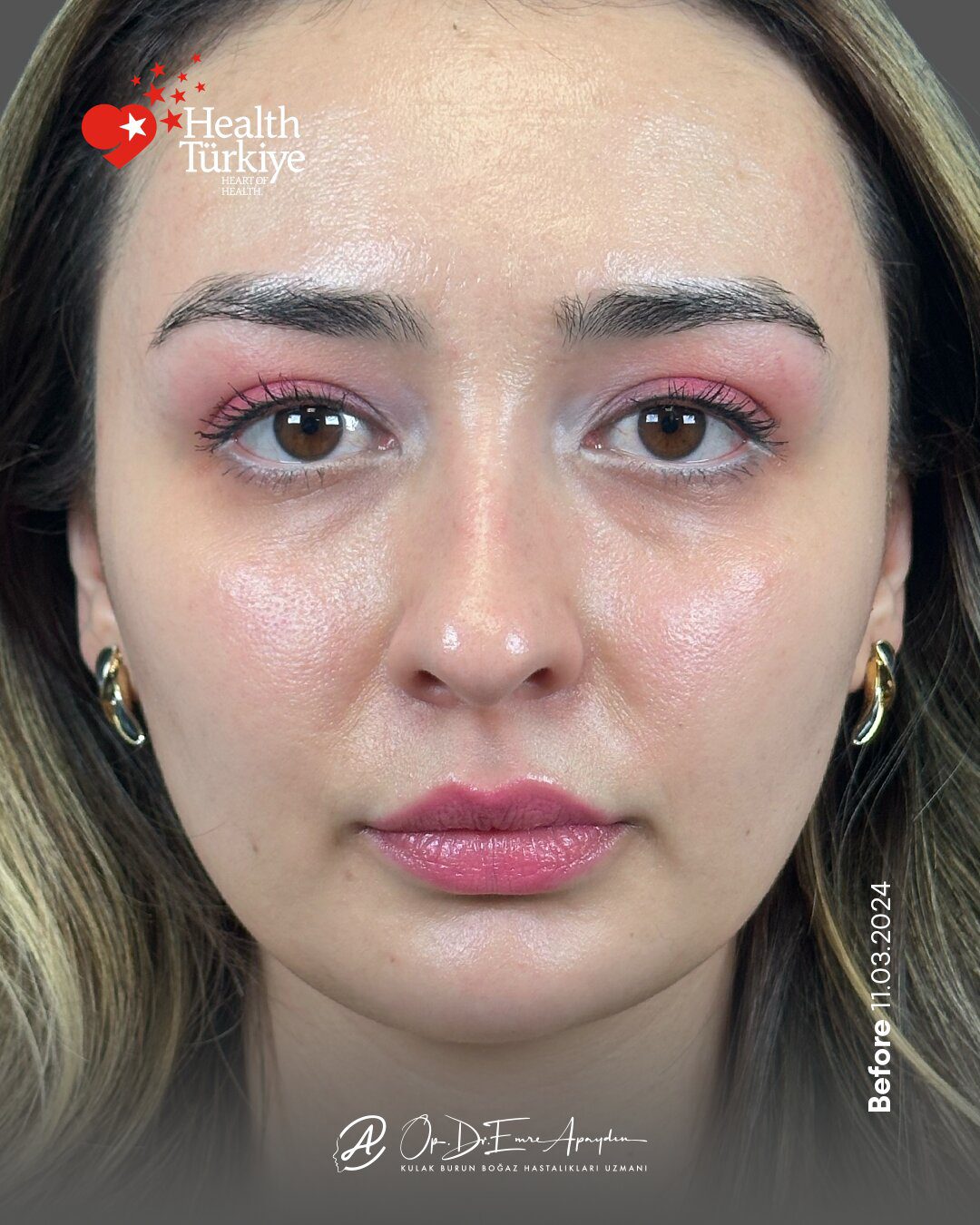EA26 09c RinoplastiBeforeAfter