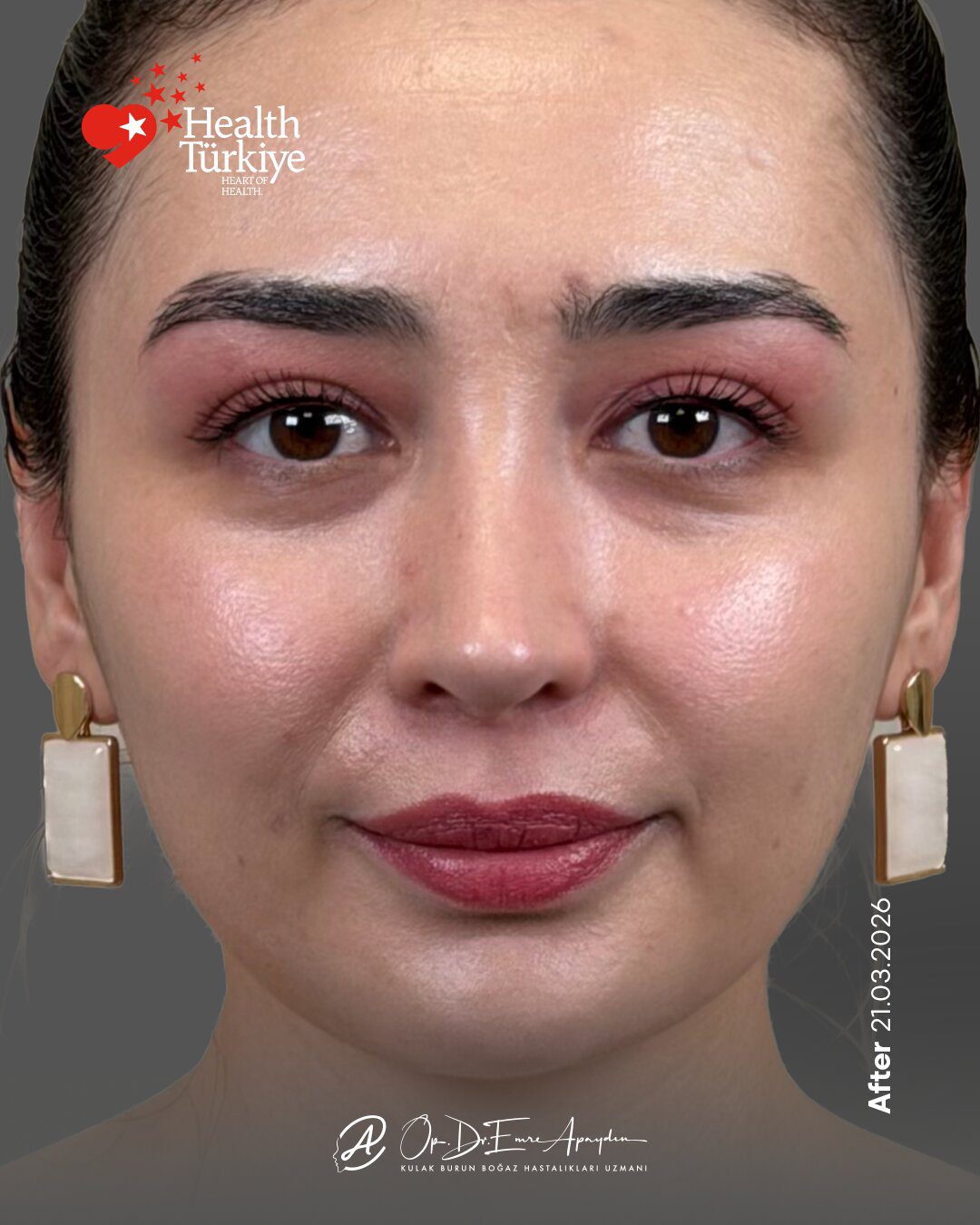 EA26 09d RinoplastiBeforeAfter