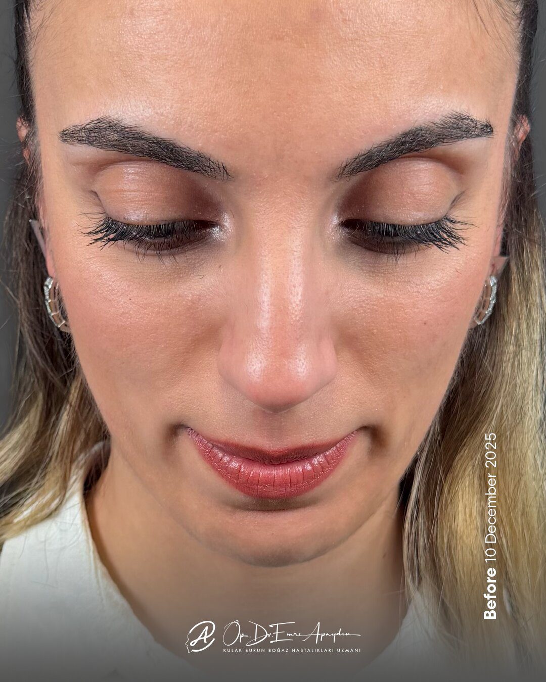 EA26 10h RinoplastiBeforeAfter
