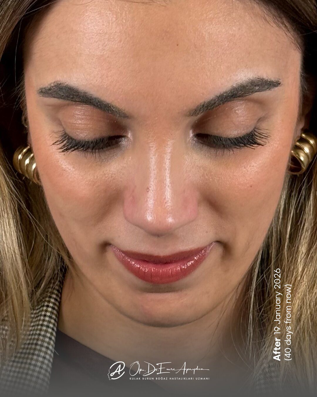 EA26 10i RinoplastiBeforeAfter