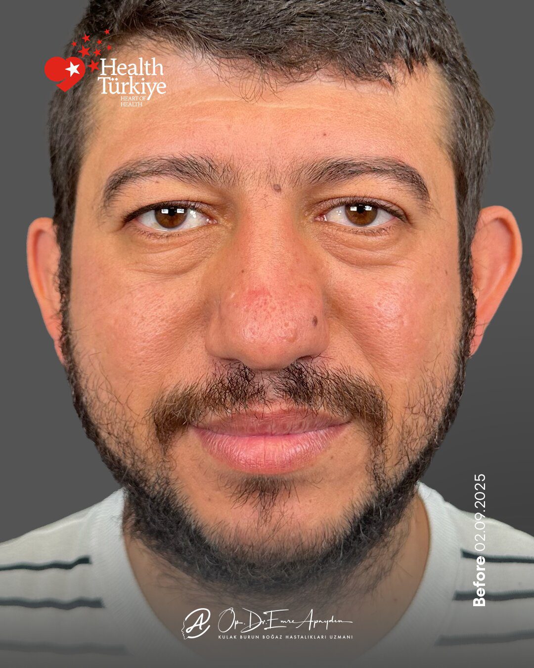 EA26 11d RinoplastiBeforeAfter