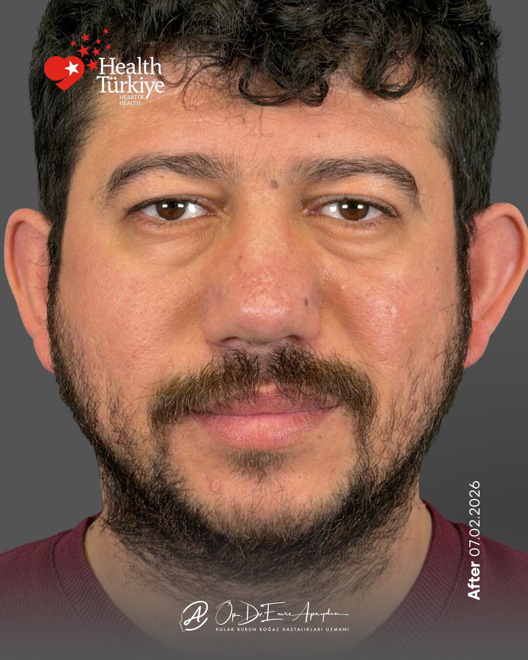 EA26 11e RinoplastiBeforeAfter